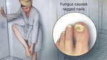 Nail Fungus Treatment For Toe and Finger Nail Fungal Infections #1 Natural Cure