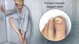 Nail Fungus Treatment For Toe and Finger Nail Fungal Infections #1 Natural Cure