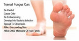 Nail Fungus Treatment For Toe and Finger Nail Fungal Infections #1 Natural Cure